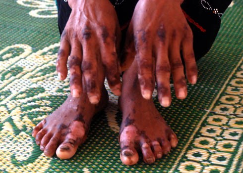 Most patients suffer from such symptoms on their hands Most patients suffer from such symptoms on their hands